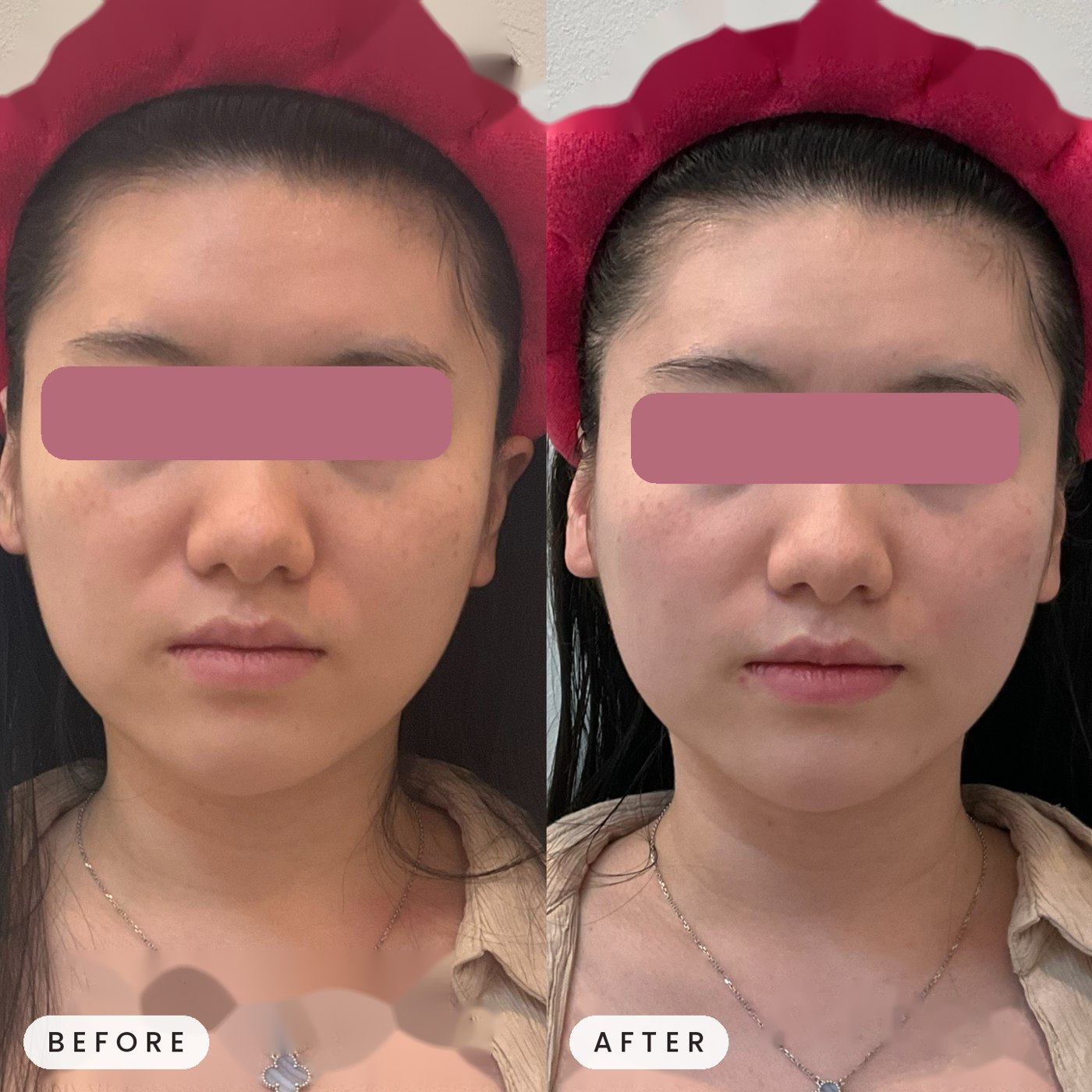 Onda facial contouring before and after