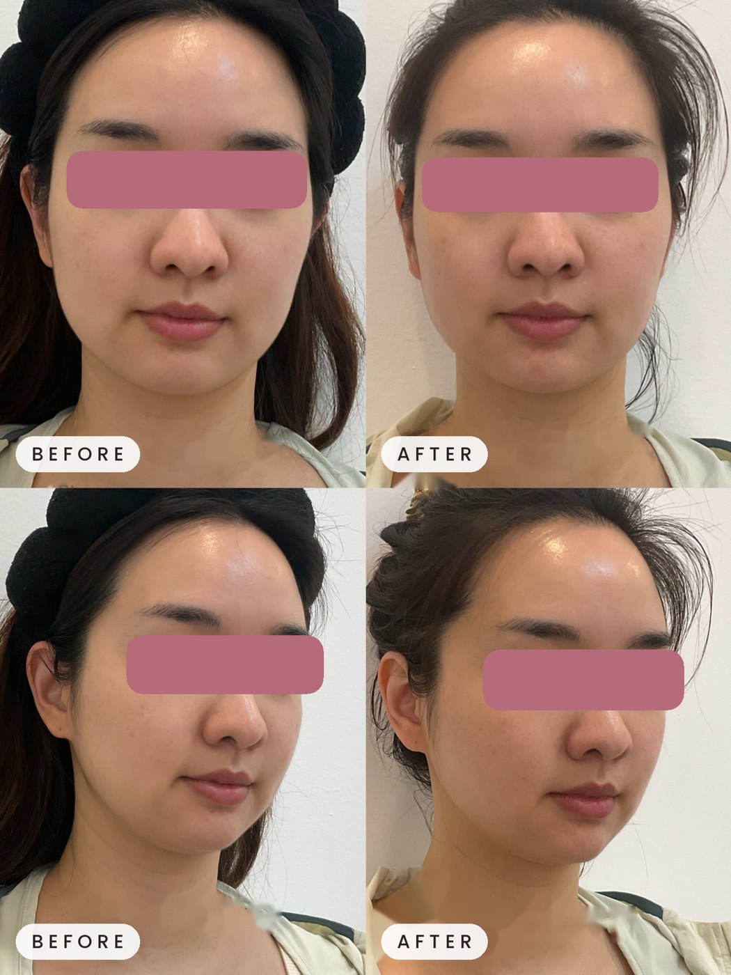 Onda face contouring result