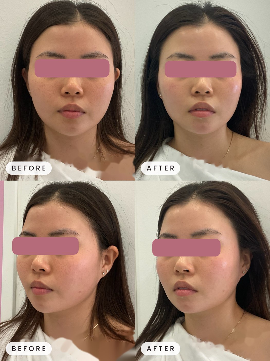 Onda face contouring result