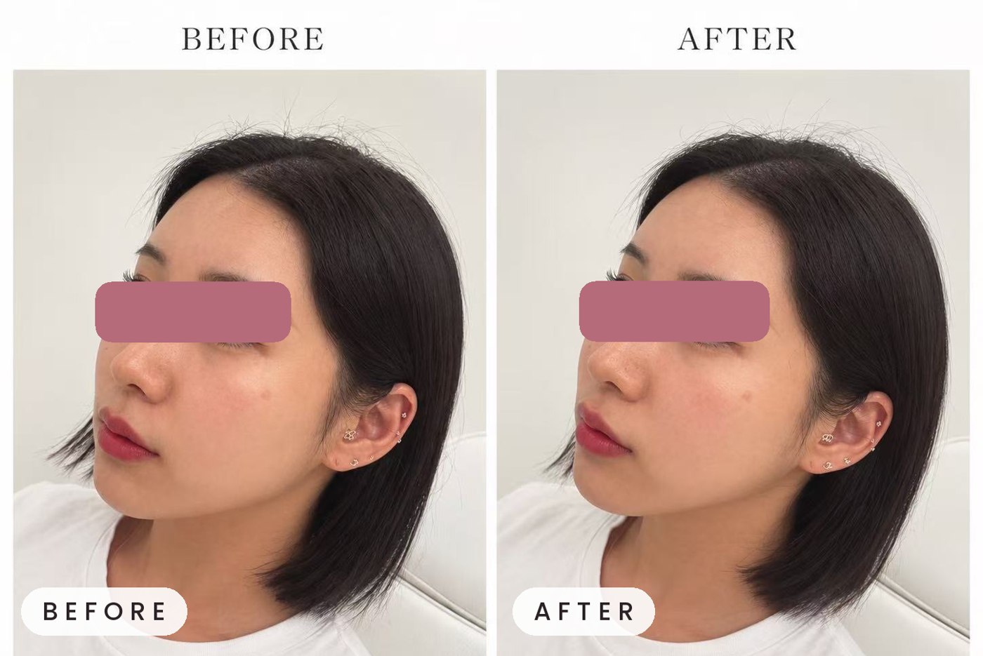 Onda facial contouring before and after
