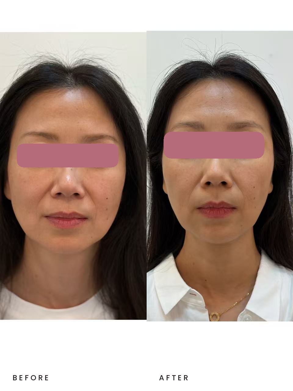 Thermage and Sculptra combo result