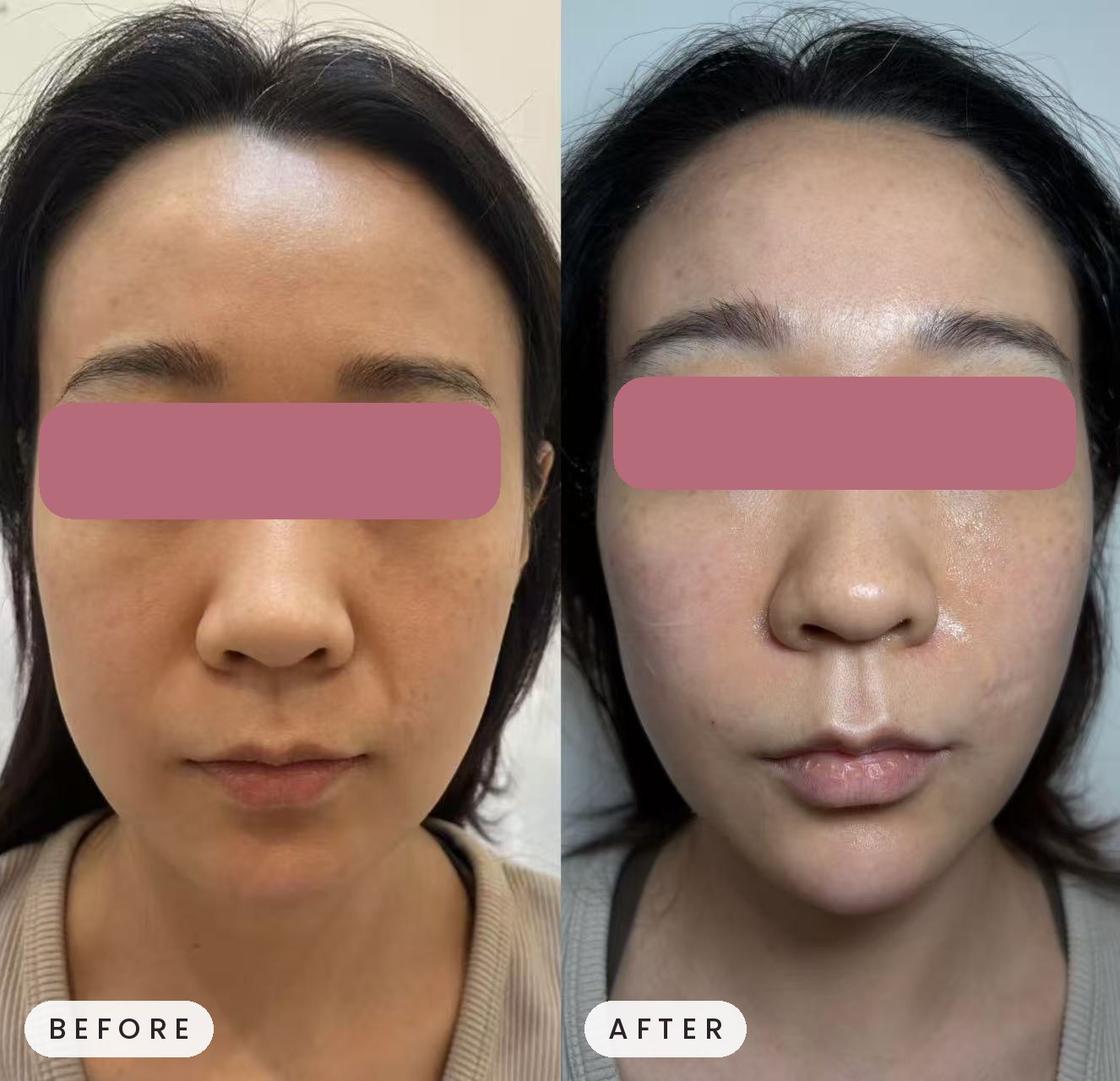 Sculptra before and after at Navila Aesthetic Lounge