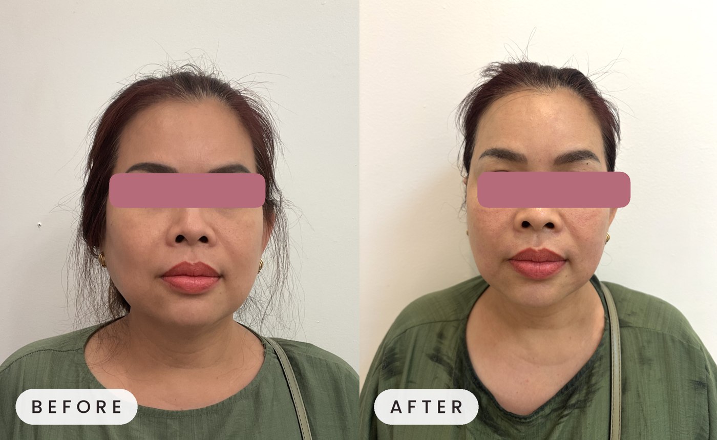 Ultherapy before and after — lower face contour