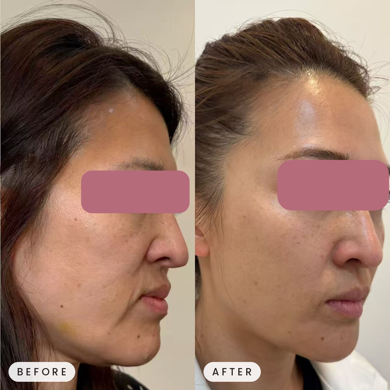 Sculptra before and after