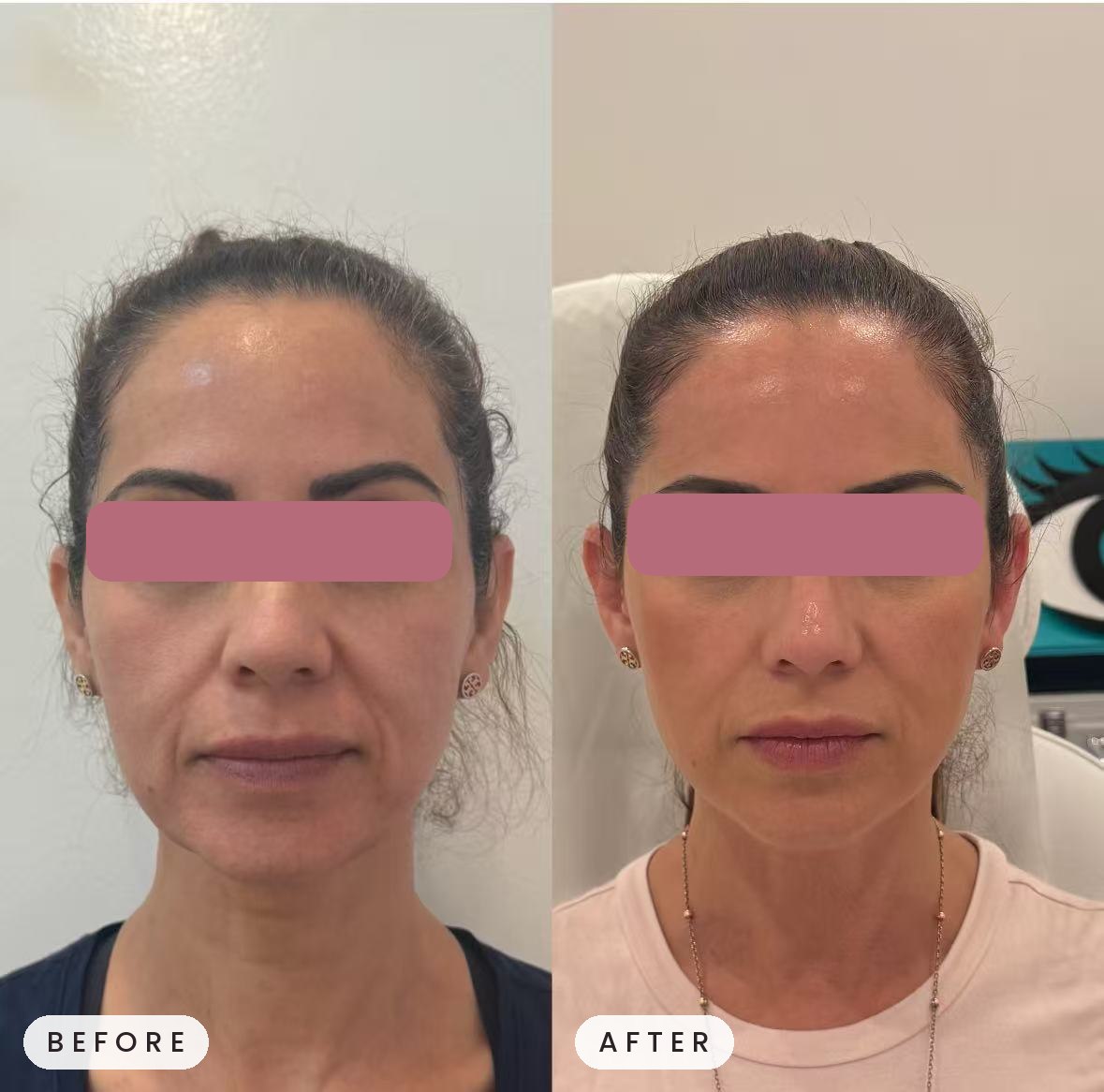 Sculptra before and after