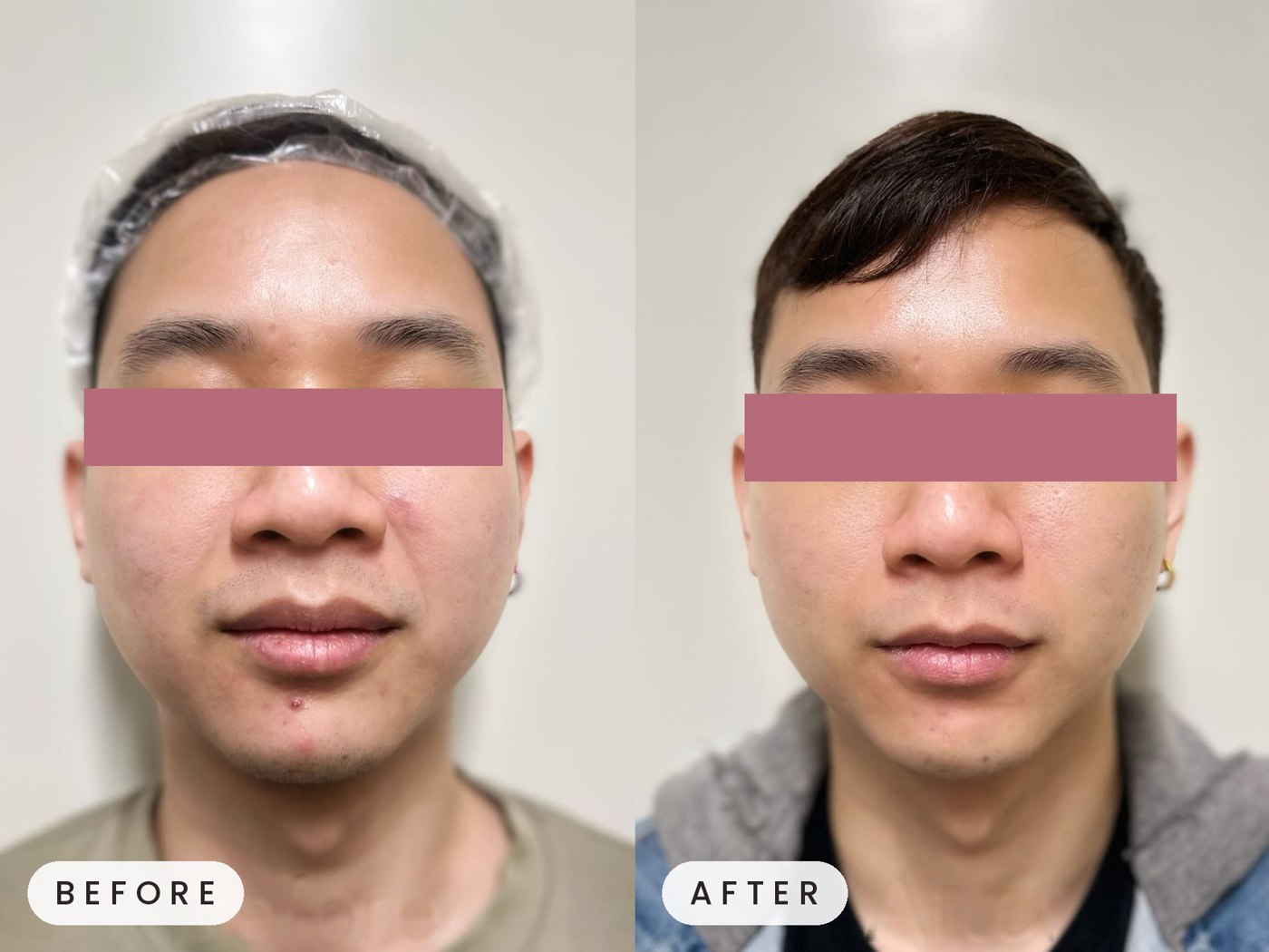 Thermage treatment result