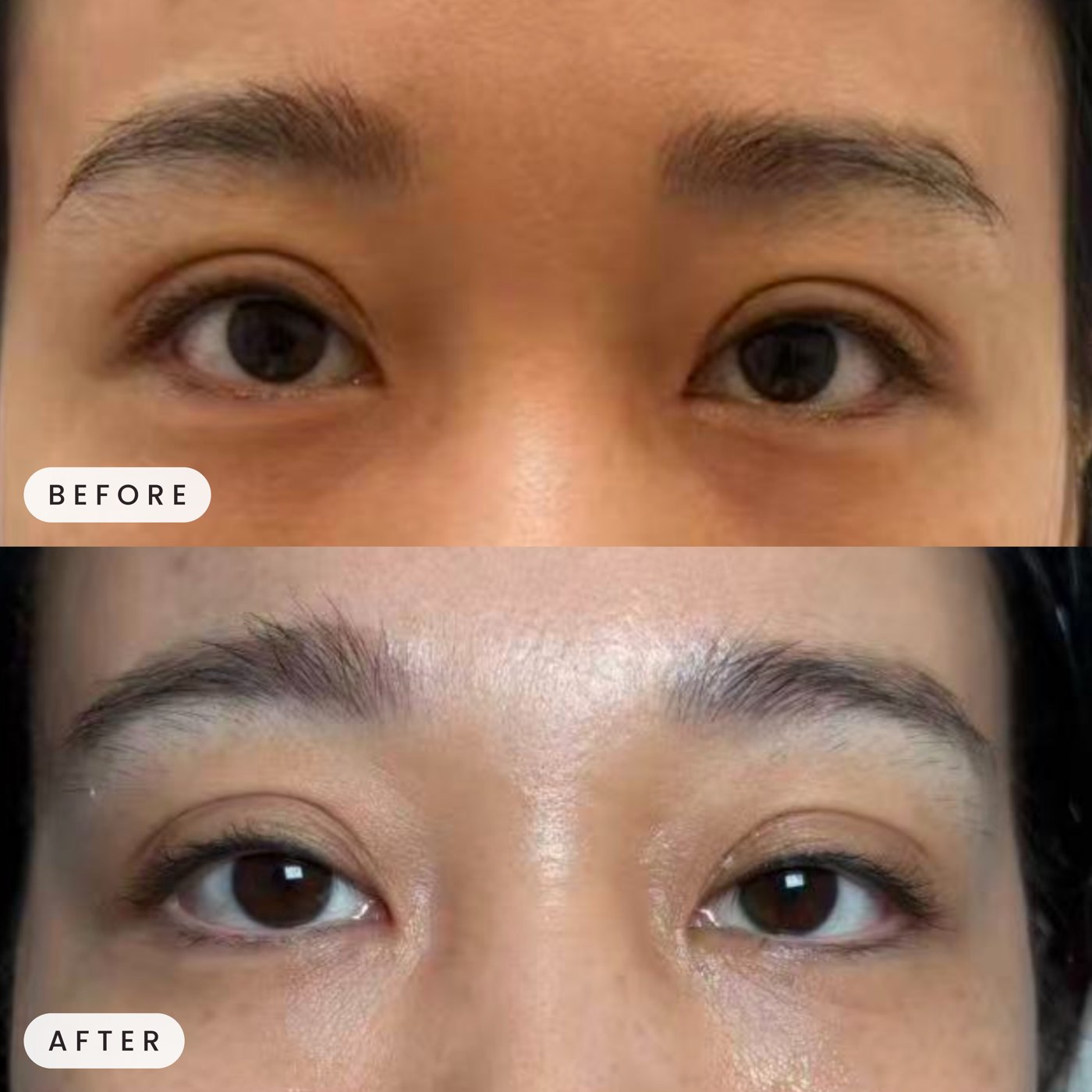 Thermage eye area before and after