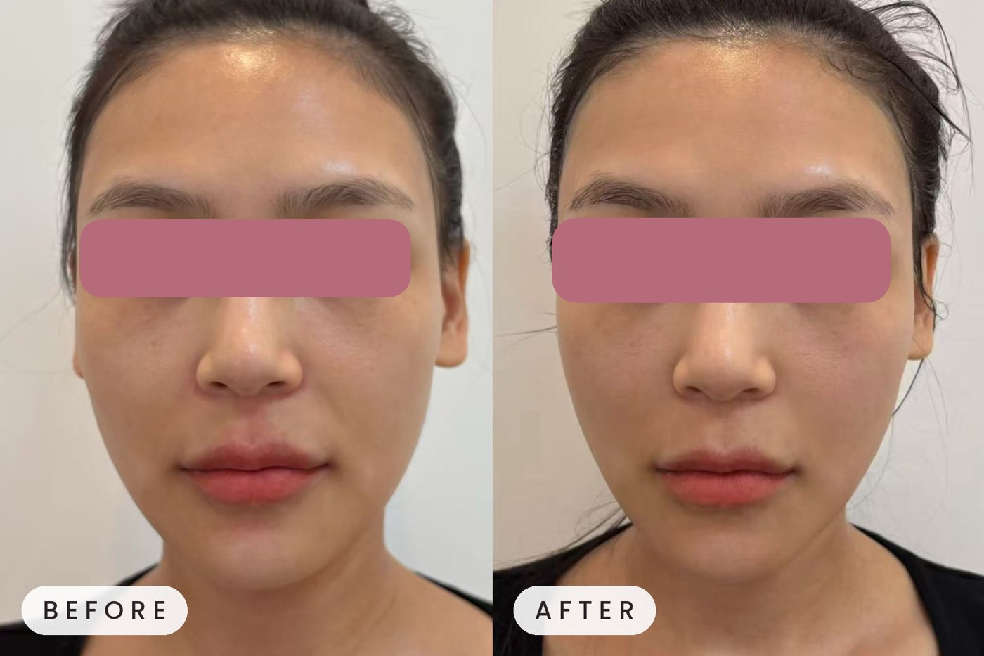 Thermage treatment result