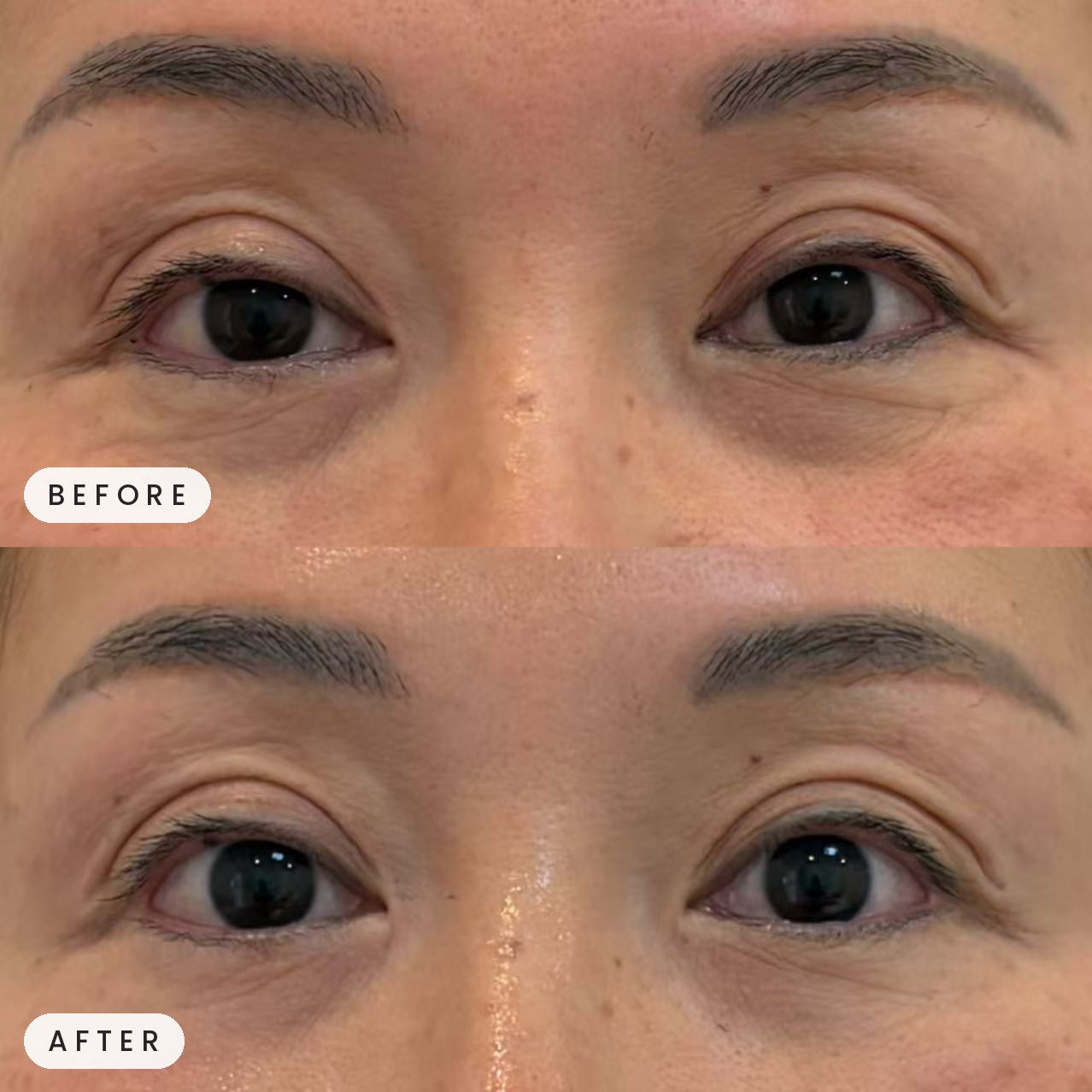 Thermage eye area before and after