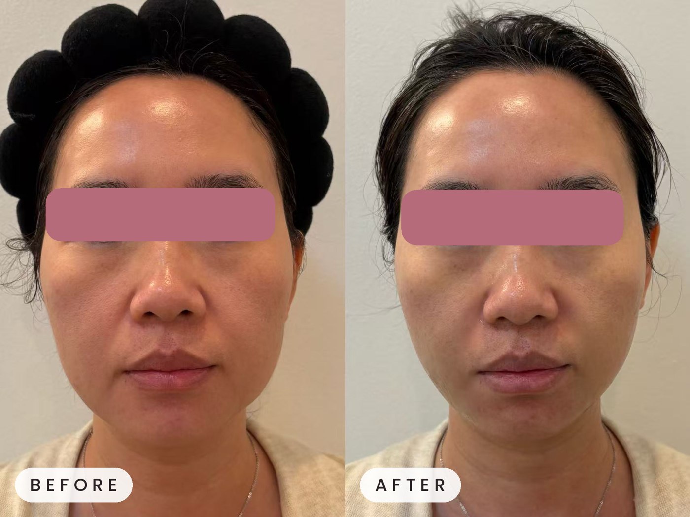 Thermage and Ultherapy combination treatment before and after