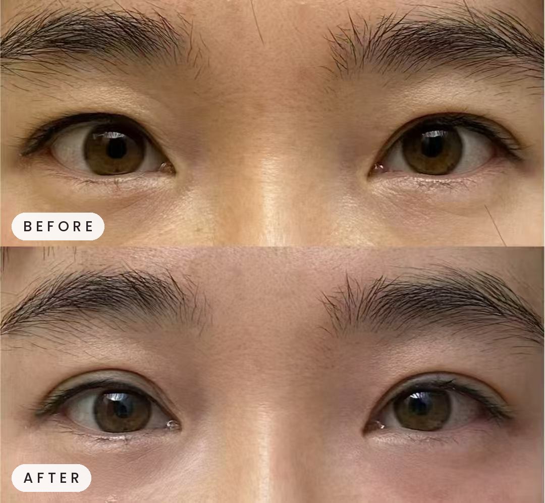 Thermage treatment result