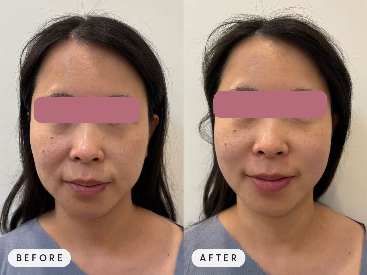 Thermage treatment result