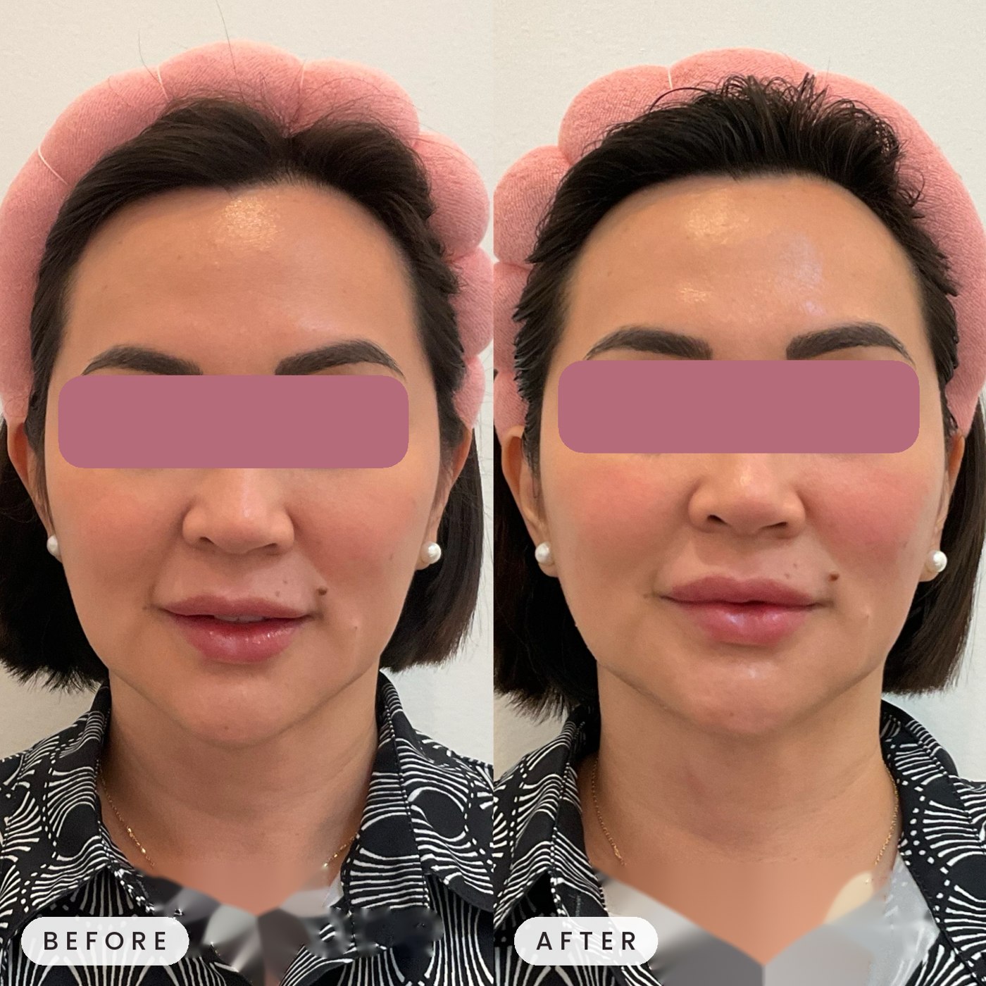 Thermage treatment result