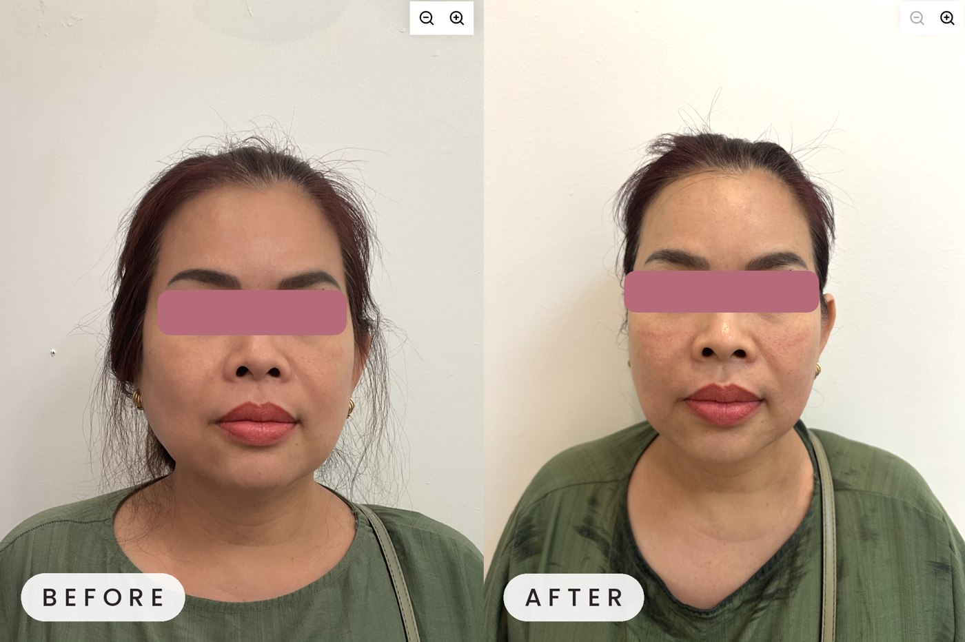 Ultherapy before and after — lower face