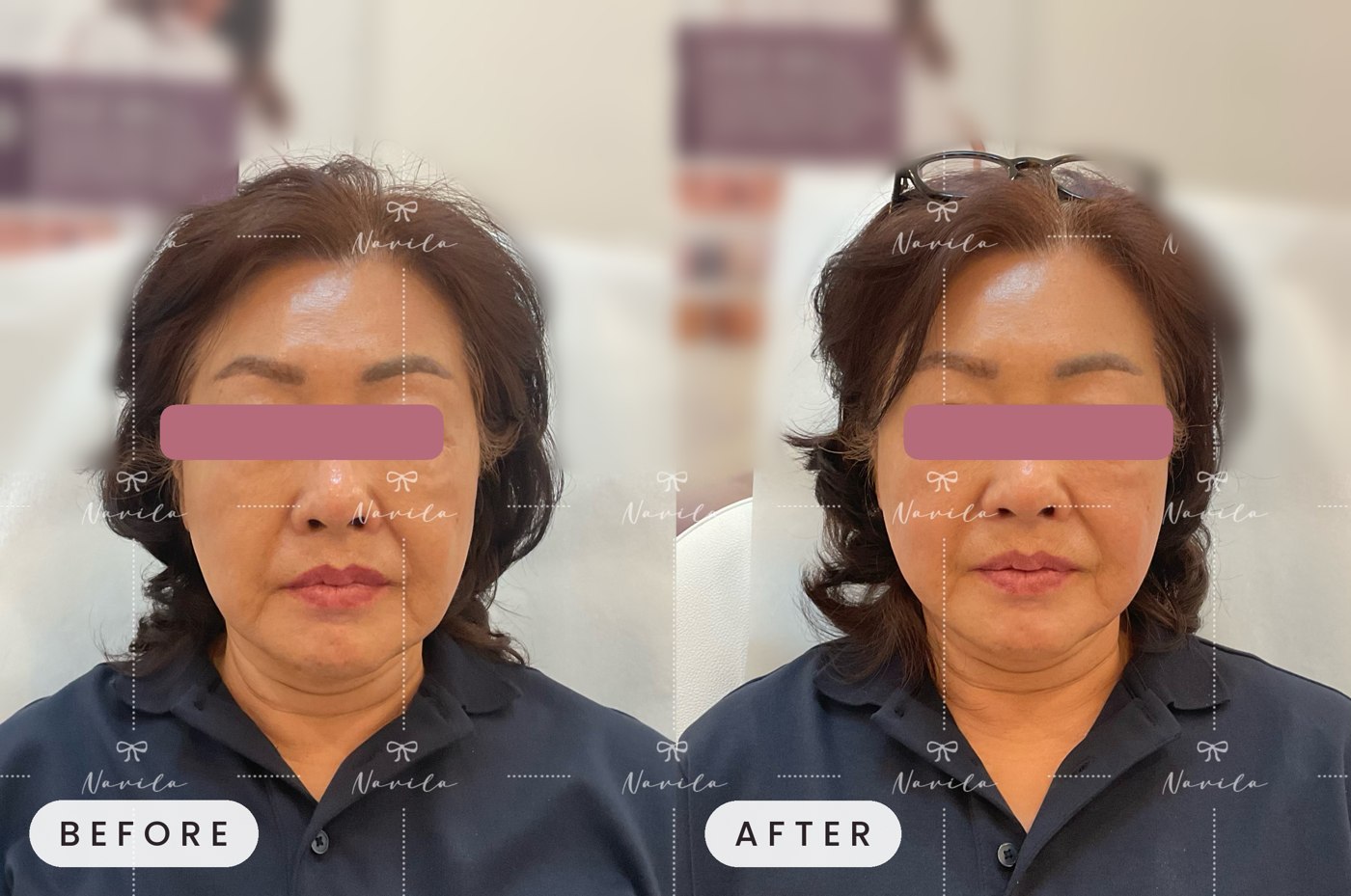 Ultherapy before and after at Navila Aesthetic Lounge