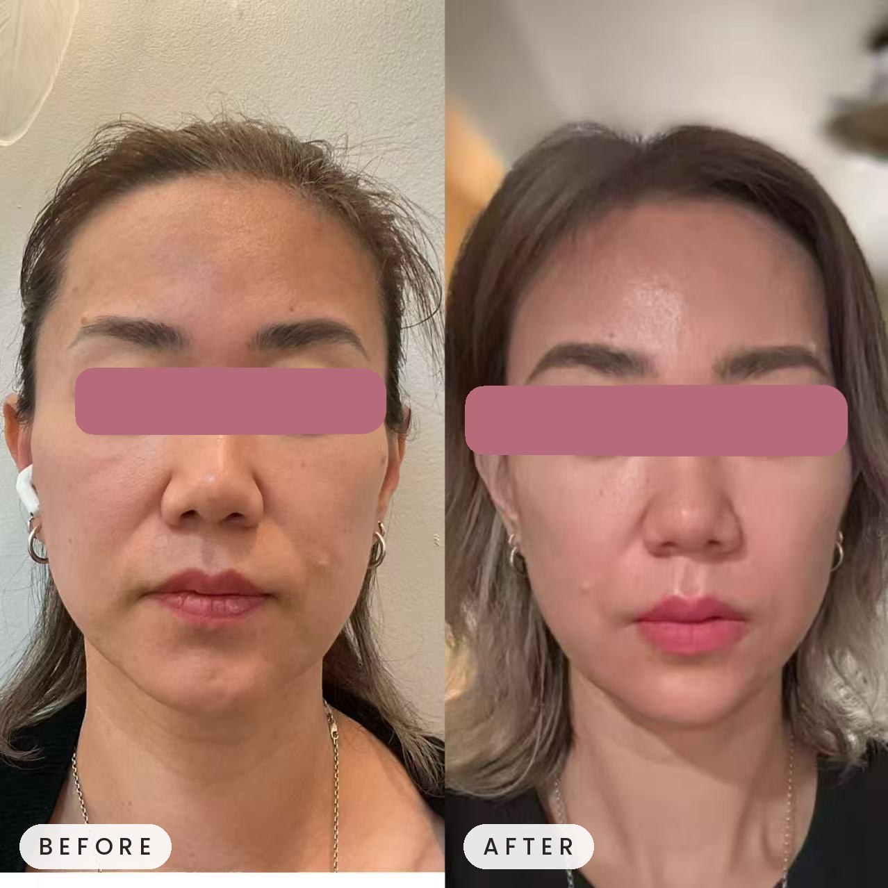 Microneedling, Botox, and Ultherapy combo result