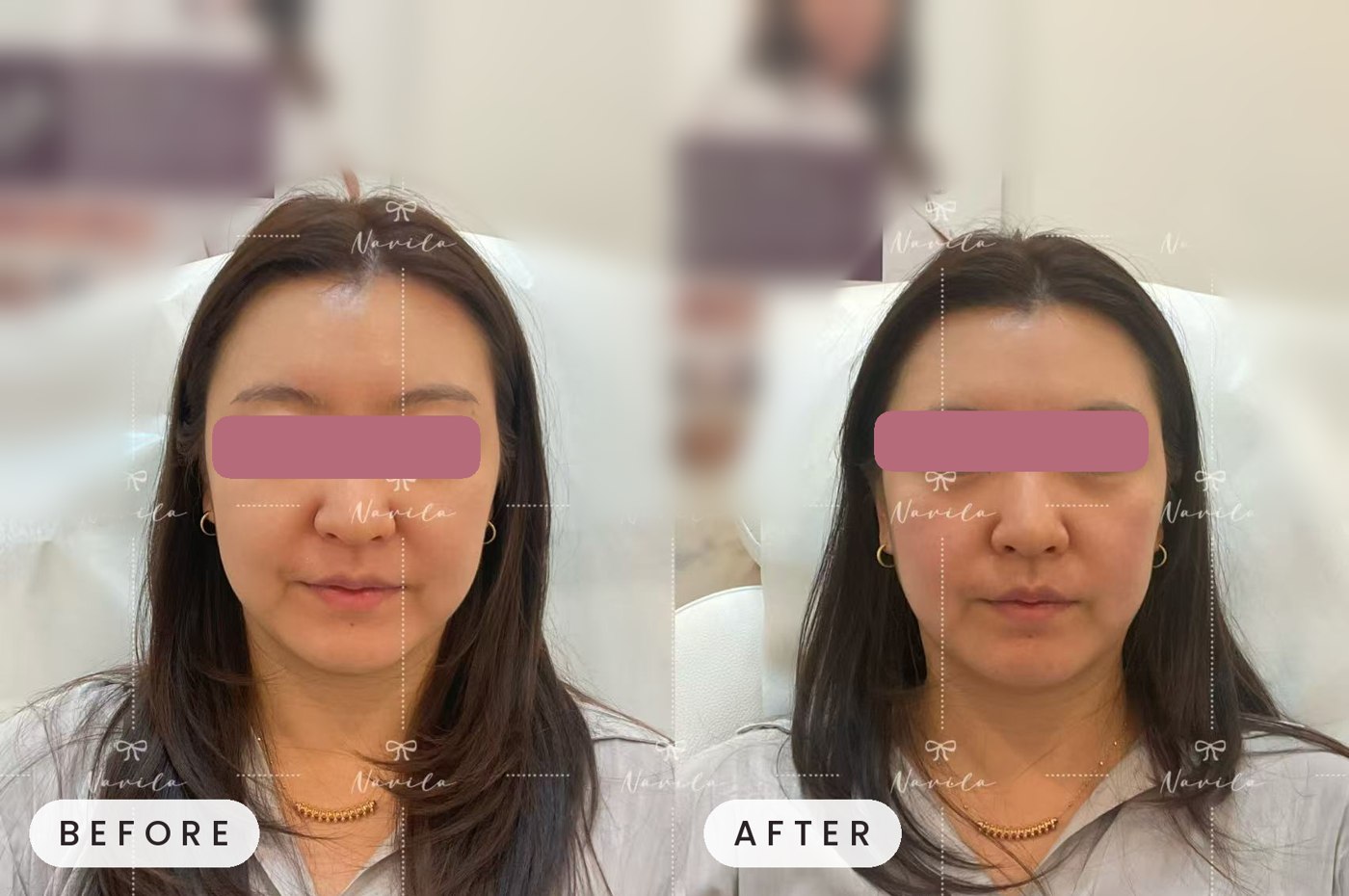 Injectables and skin boosters