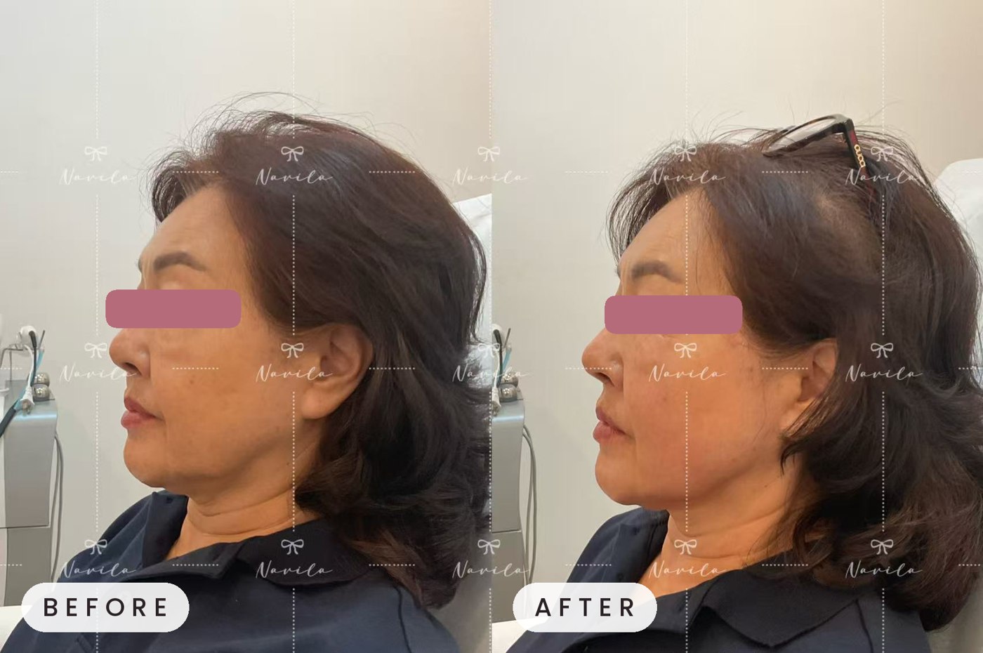 Ultherapy before and after