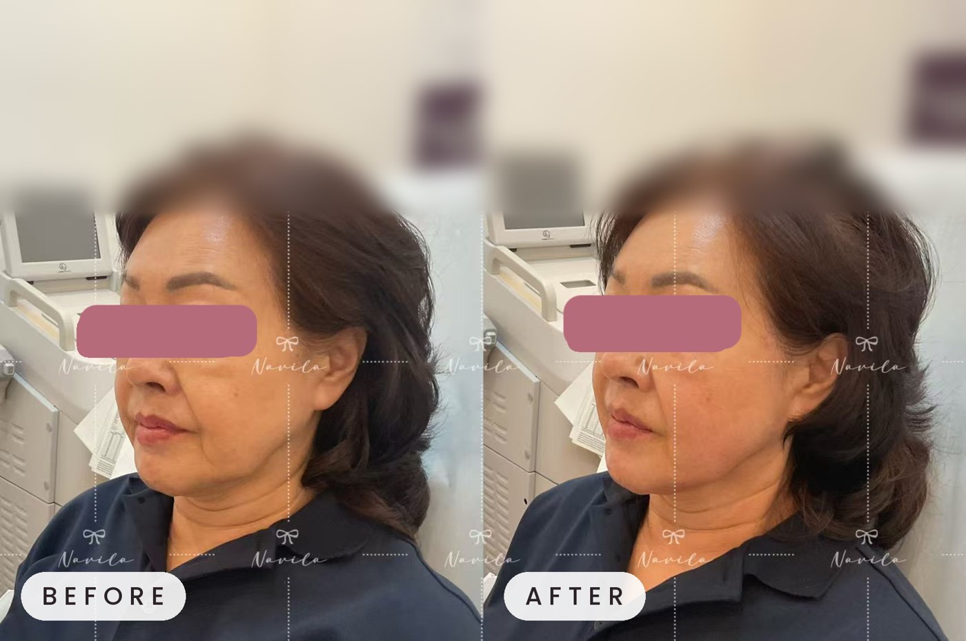Ultherapy before and after — three-quarter view jawline definition