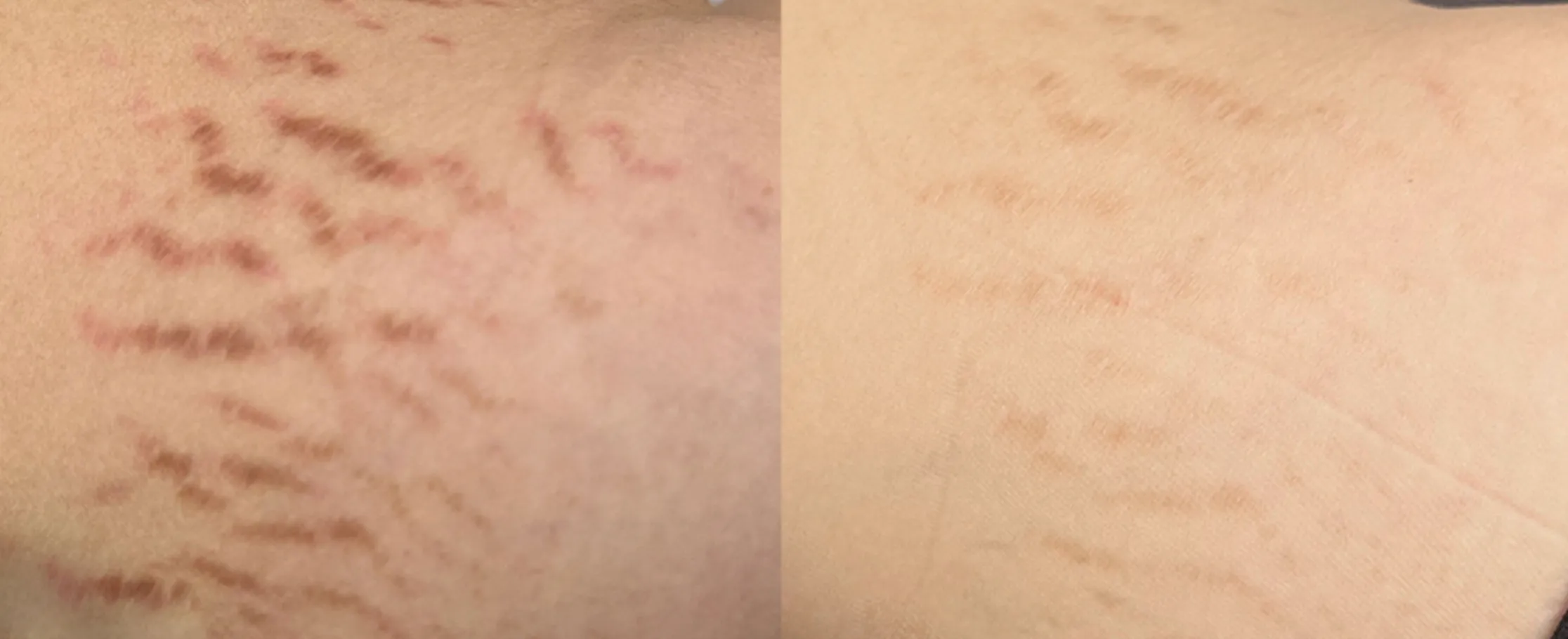 Picofy clinical before and after