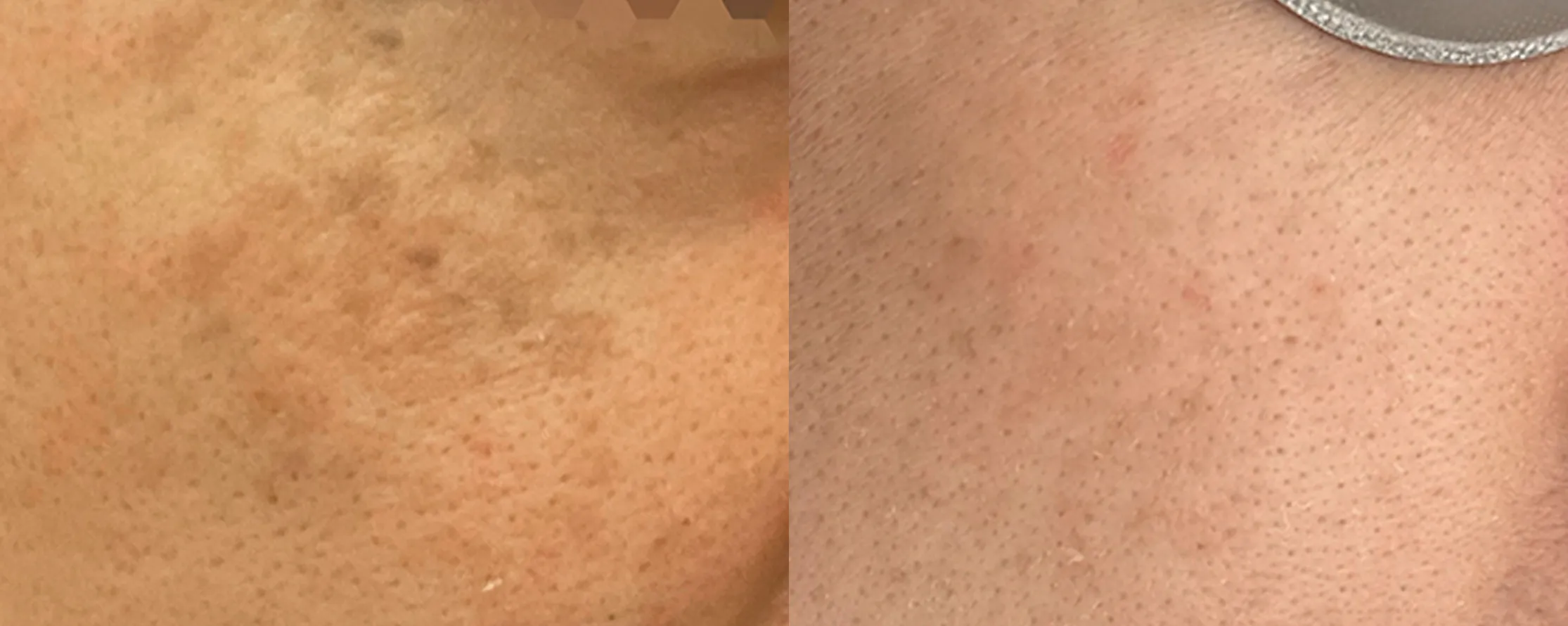 Picofy clinical before and after