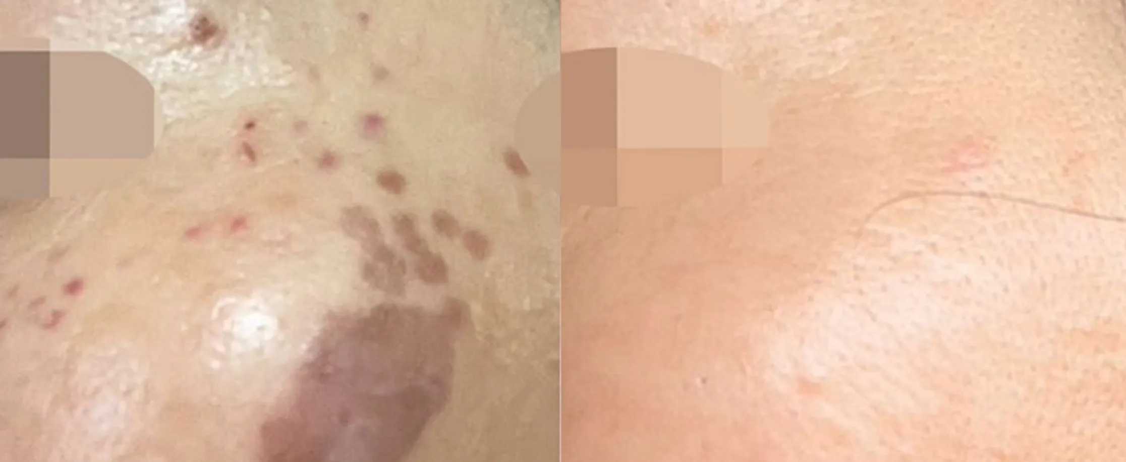 Picofy clinical before and after