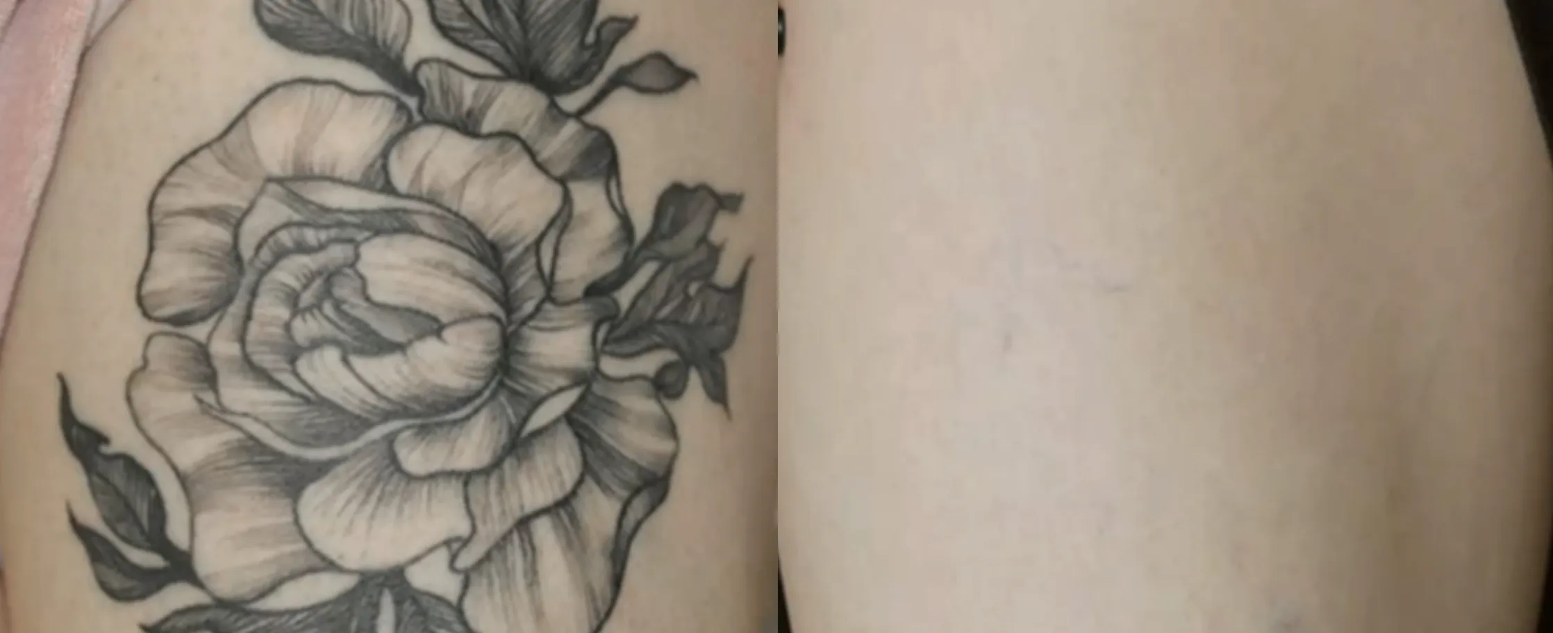 Picofy clinical before and after