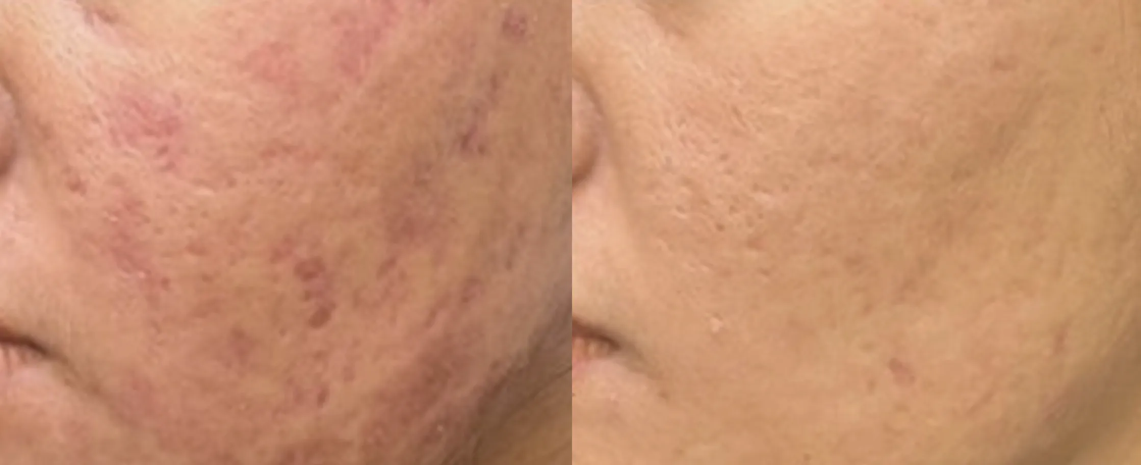 Picofy clinical before and after