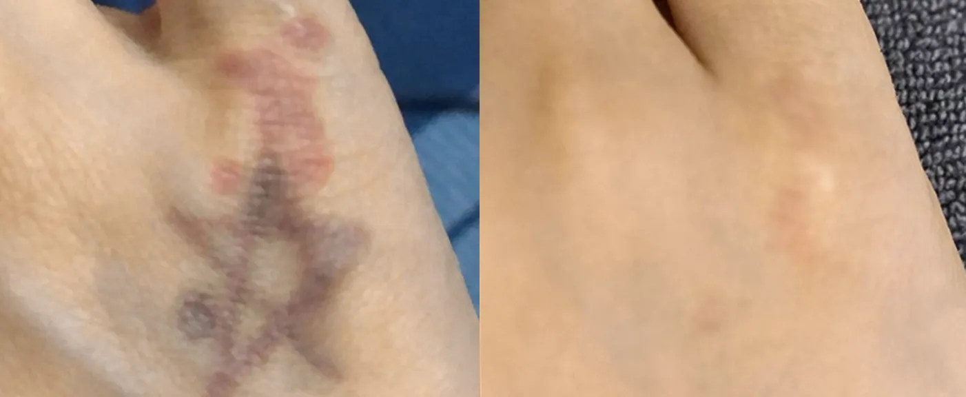 Picofy before and after