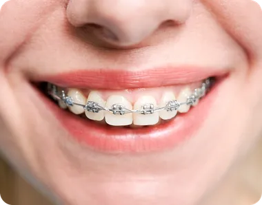 Close-up of a smile with metal braces