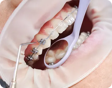 Orthodontist checking braces with a dental mirror