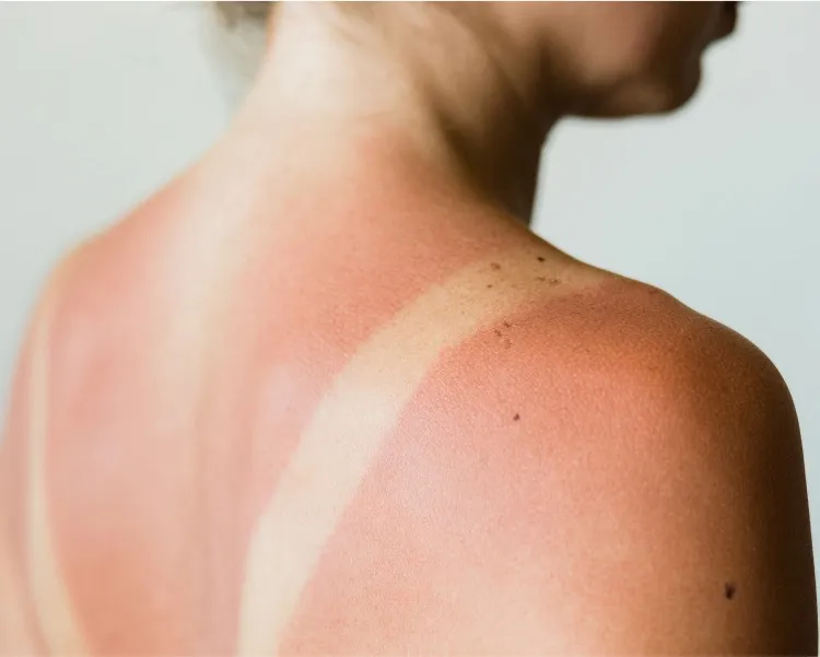 Melasma and Dark Patches: Why Diagnosis Matters for Skin of Color