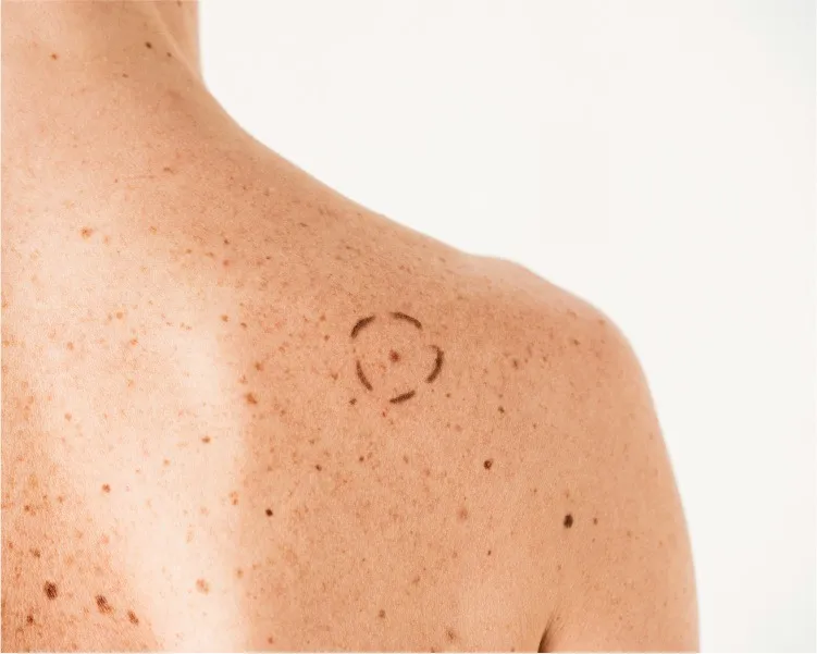 The ABCDEs of Melanoma and the Signs That Need a Skin Exam