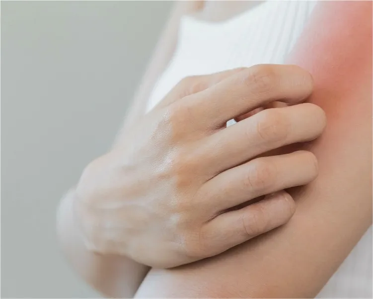 Eczema in Winter: How to Protect Your Skin Barrier in Maryland and Virginia