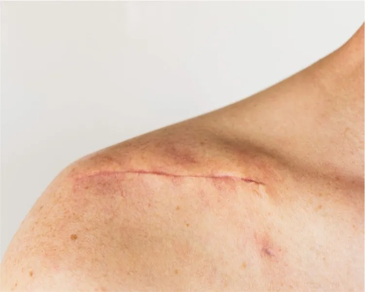 Acne Marks or Acne Scars? Why the Difference Changes Treatment