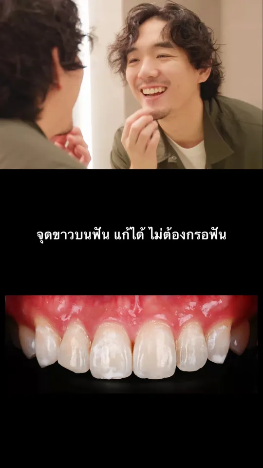 ปกวิดีโอเคสจริง จุดขาวบนฟัน