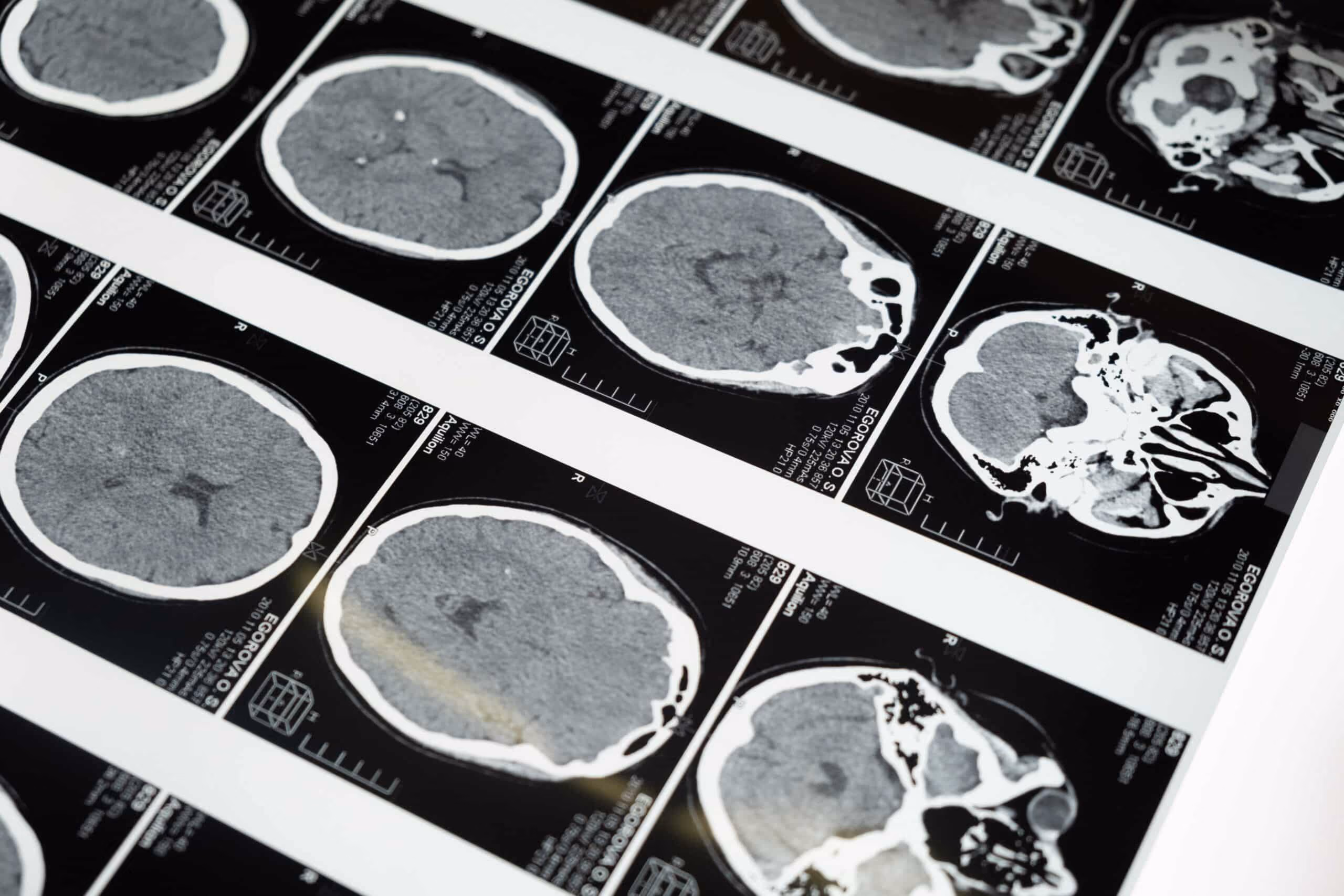 Prelude's EDC Instrumental in Conducting Head Injury Research in a Multi-Hospital Study