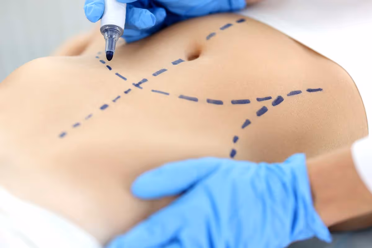 Was kostet eine Liposuktion?