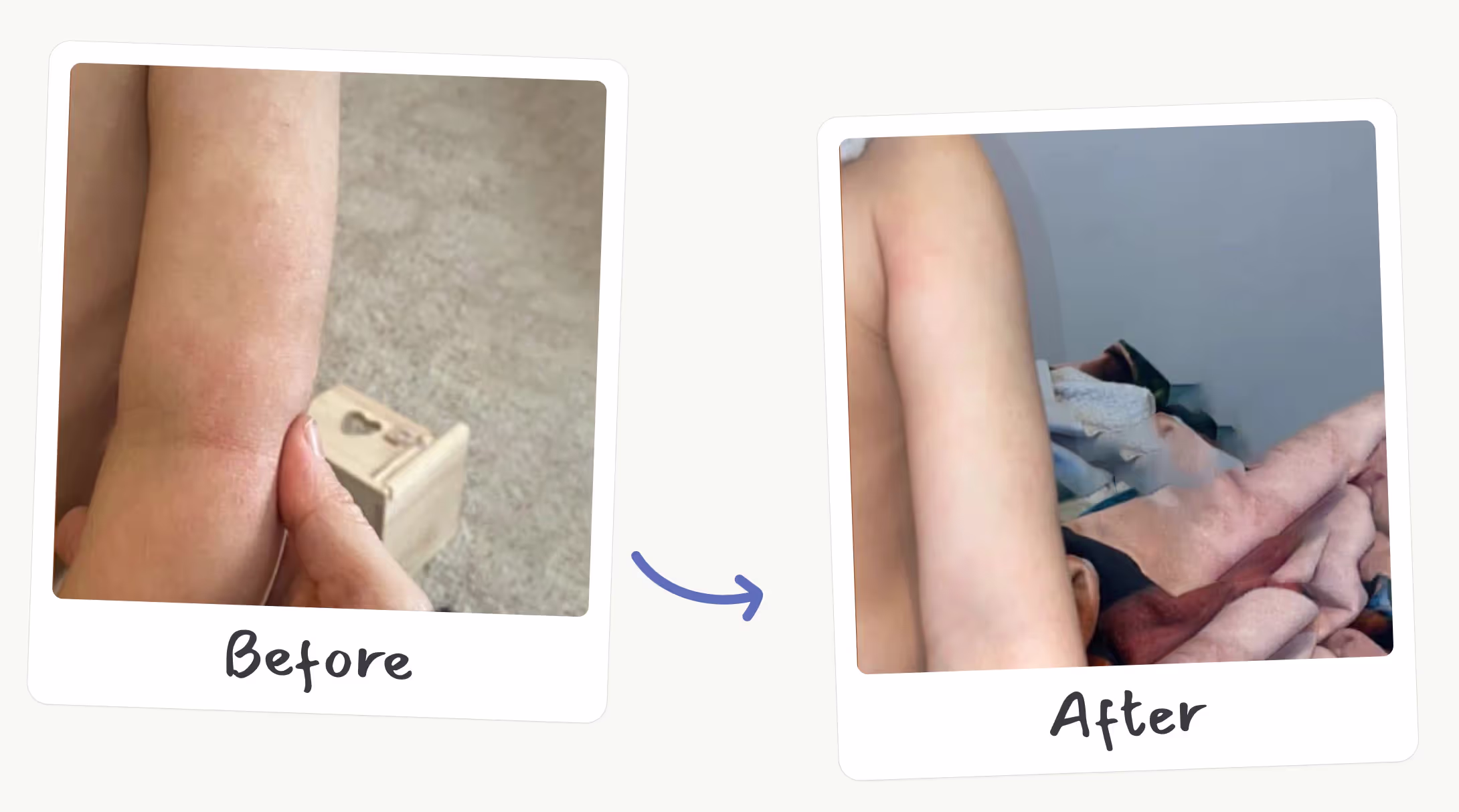 Before and after photos of a baby's arm showing improvement in eczema after dietary changes and probiotic treatment