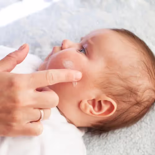 A parent applies cream to their baby with eczema's skin