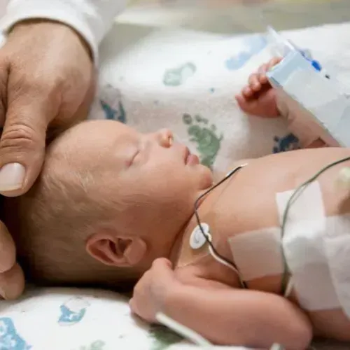 Preterm infant receiving medical care, connected to monitors in a hospital setting