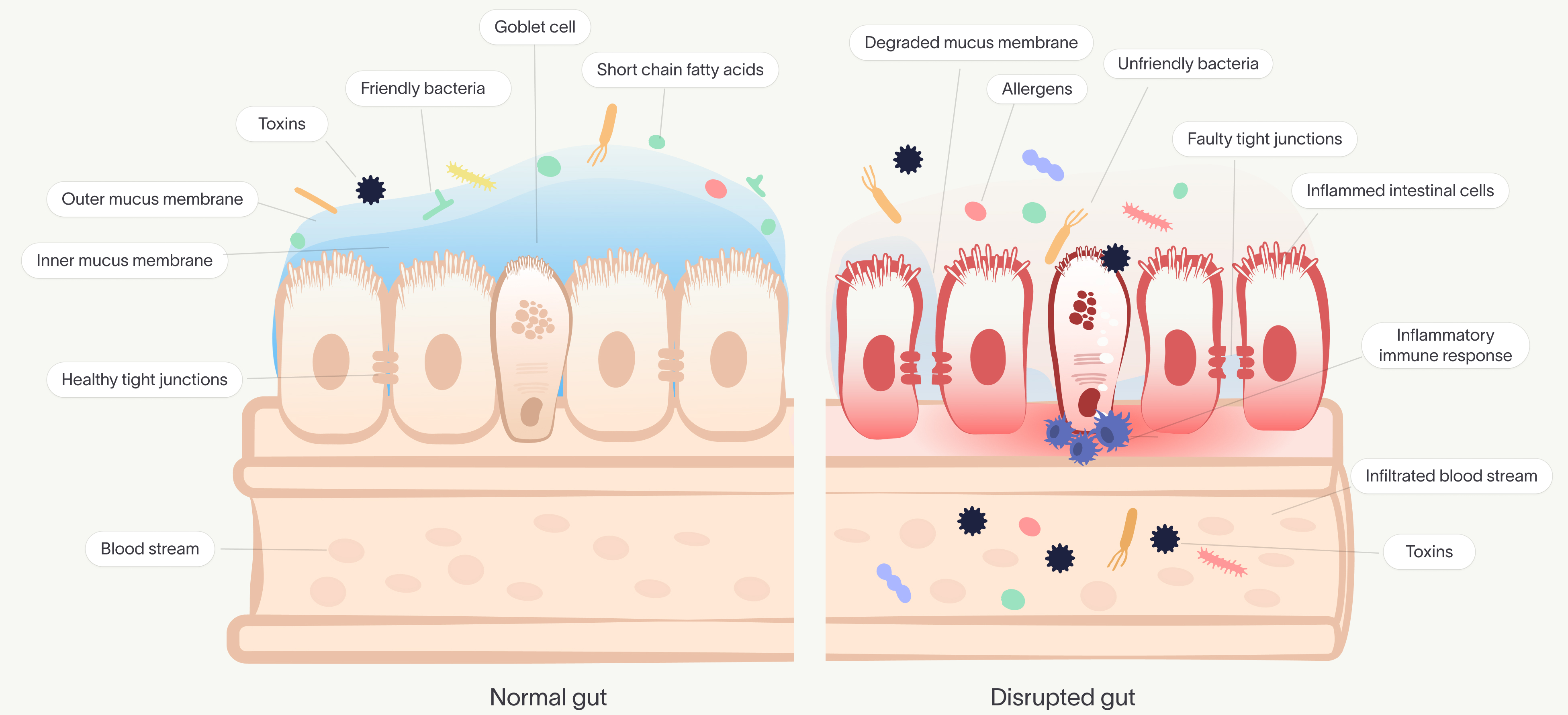 Side-by-side illustration of a normal gut with healthy tight junctions and a disrupted gut lining with inflammation and toxins