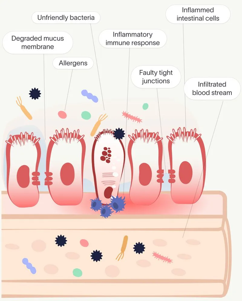 a diagram of an inflamed gut after leaky gut syndrome