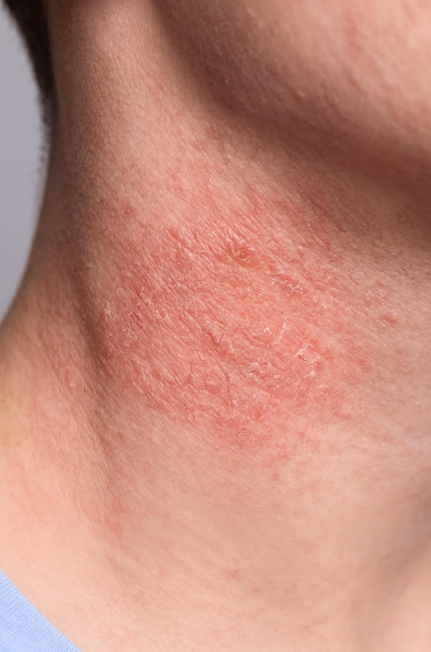 Eczéma & Peau sèche
