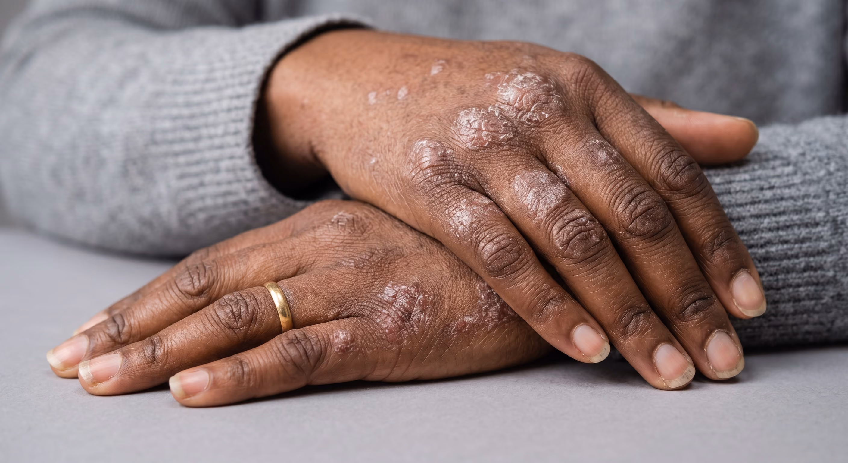 Psoriasis & Maladies inflammatoires chroniques