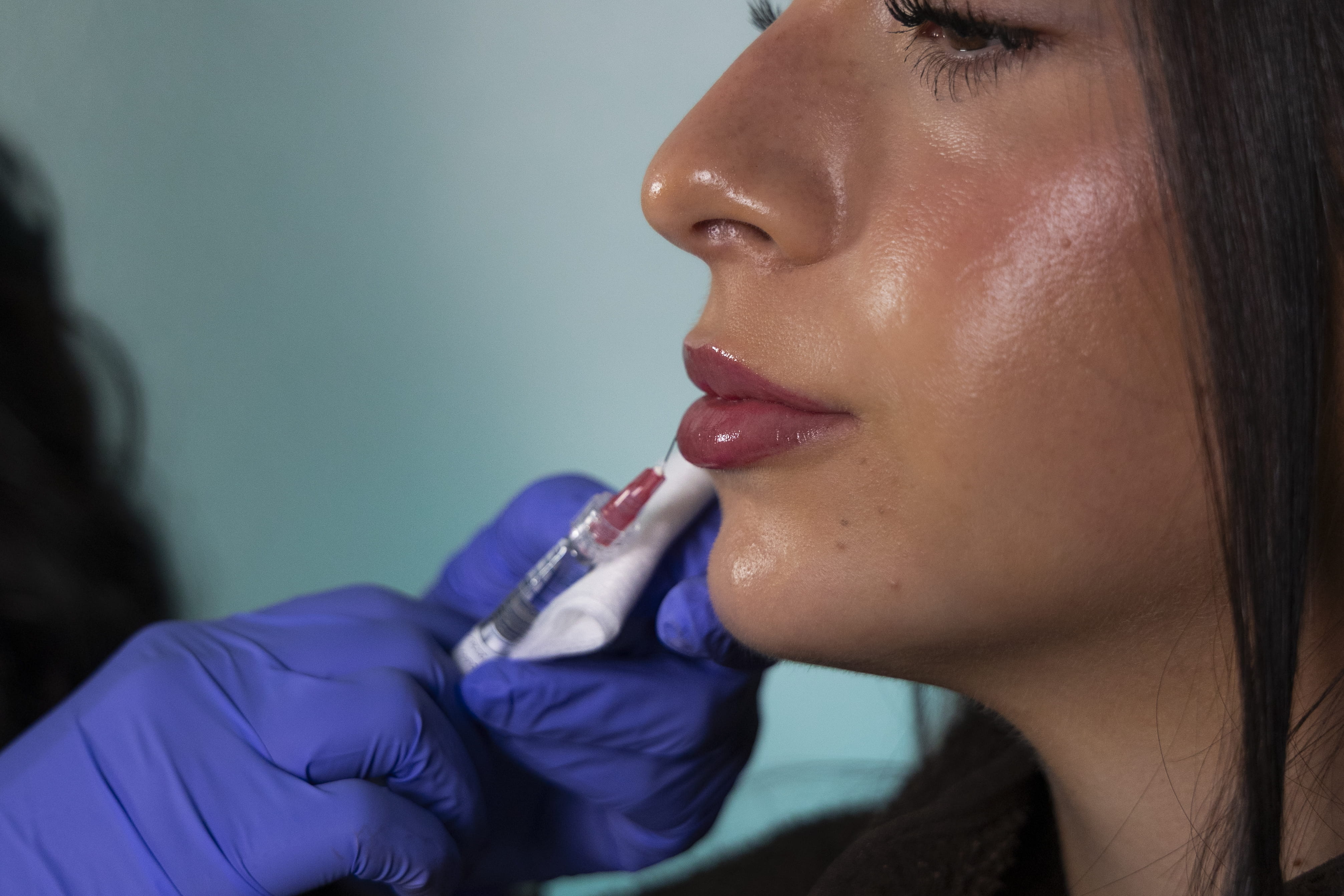 Lip enhancement treatment