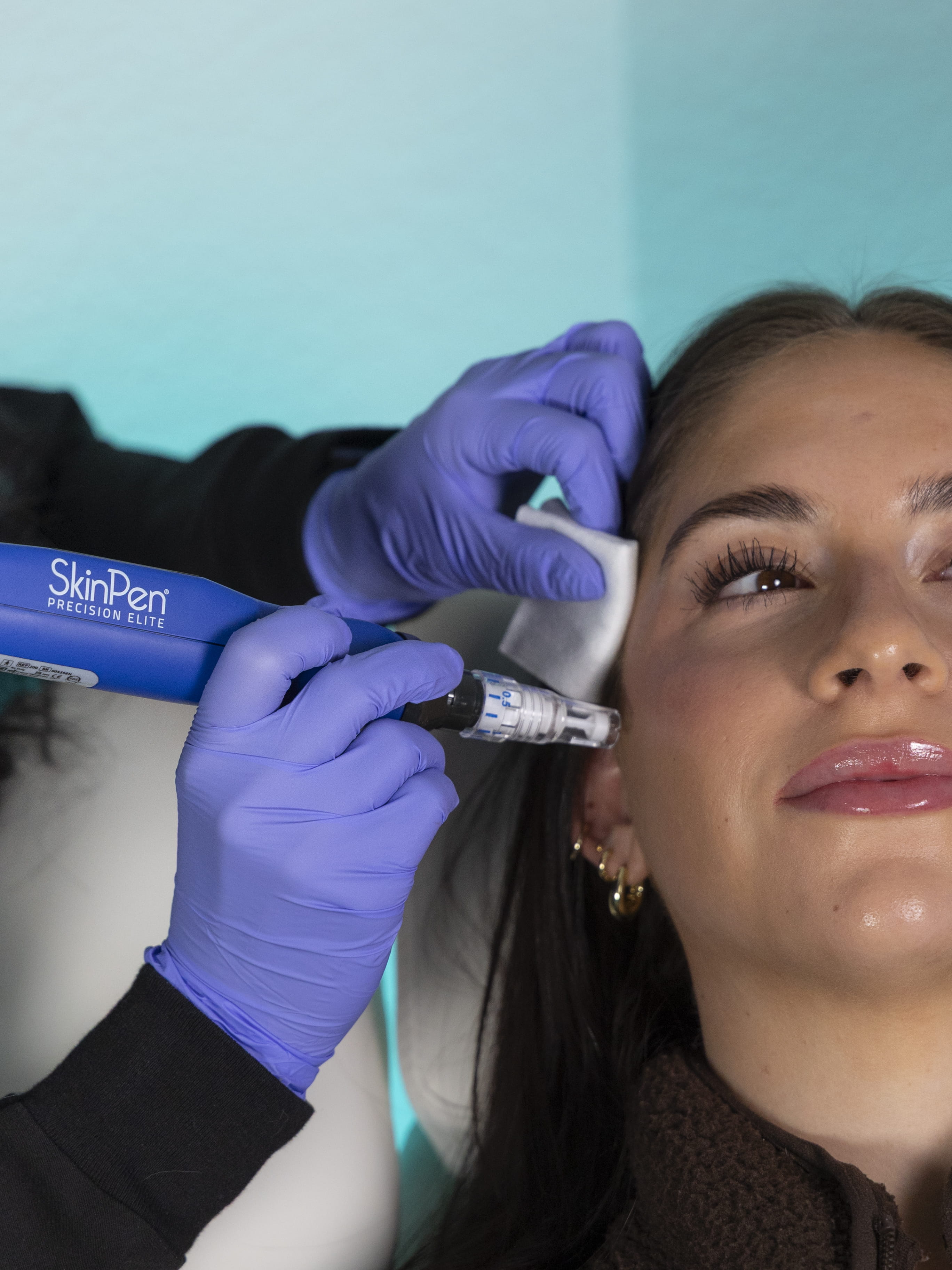 Microneedling treatment