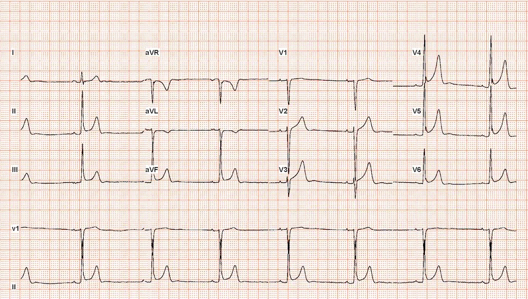 Electrocardiogram (ECG) tracing showing multiple lead readings including I, II, III, aVR, aVL, aVF, and chest leads V1 to V6, displaying heart electrical activity on standard grid paper.