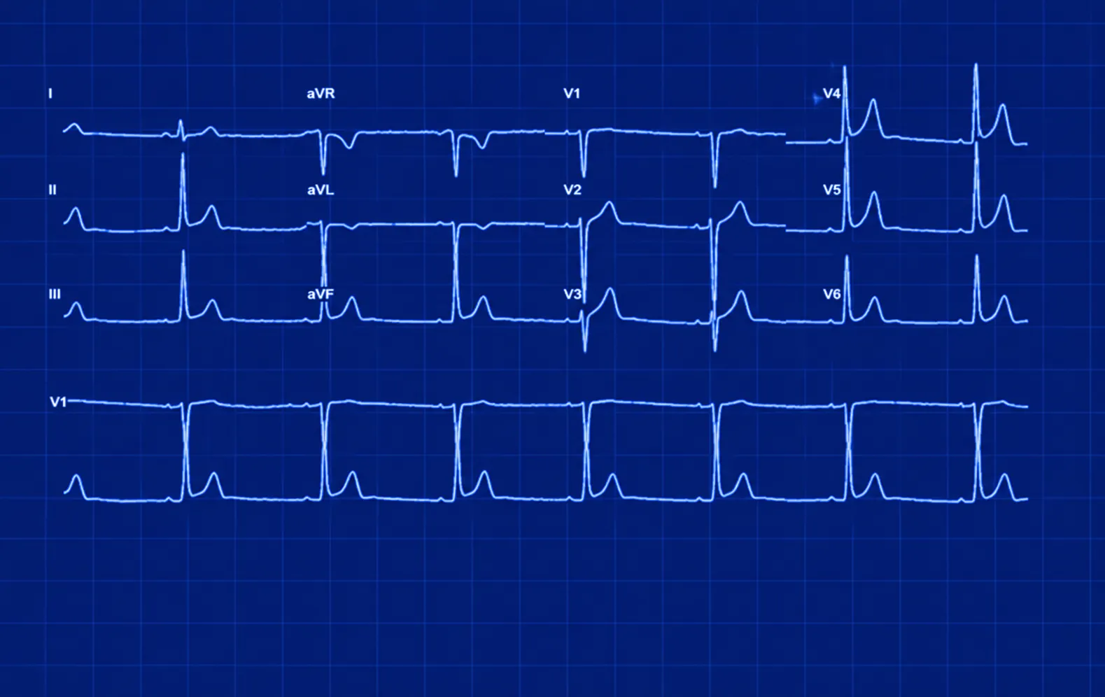 Neon blue ECG tracing on a grid background with labeled leads I, II, III, aVR, aVL, aVF, and chest leads V1 to V6 showing various heart electrical activity waveforms.