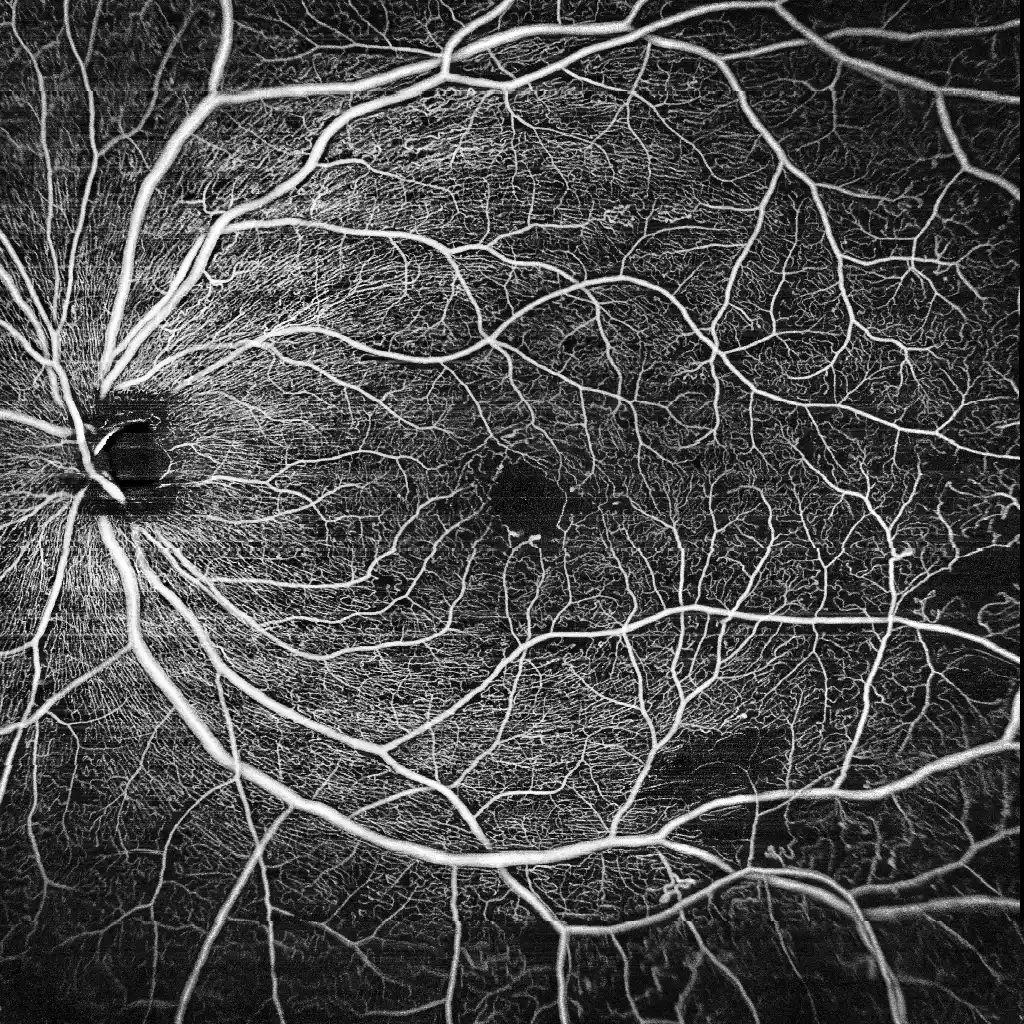 Retinopatia cukrzycowa — obraz OCTA